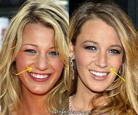 Blake Lively Plastic Surgery Comparison Photos