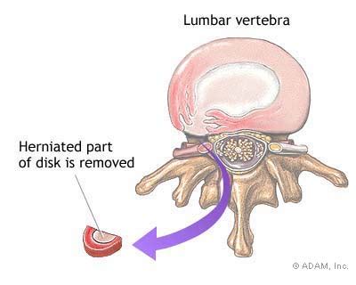 Not every disc related pain needs medical intervention. Herniated Disk Surgery and Invasive Procedures - Herniated ...