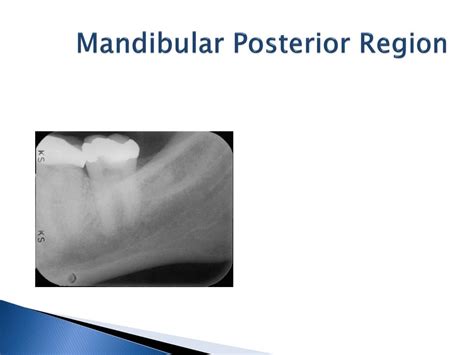 PPT EO 005 06 Normal Intraoral Radiographic Anatomy PowerPoint