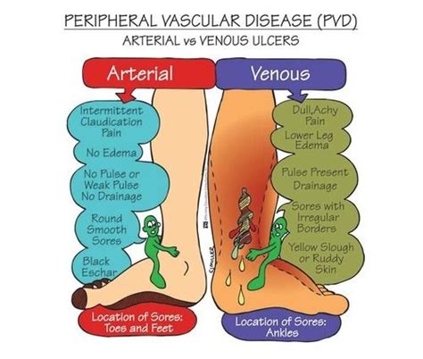 Image Result For Peripheral Artery Disease Arterial Vs Venous Nursing