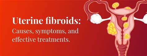 What Are Uterine Fibroids Causes Symptoms And Treatment Rela Institute