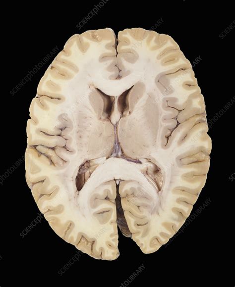 Transverse Section Of The Human Brain Stock Image C005 5982