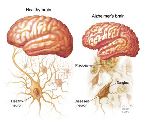 Alzheimers Disease Causes Symptoms Treatments And Nursing Care For Alzheimer Patient Healthc