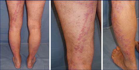 Linear Psoriasis Following The Typical Distribution Of The Sciatic