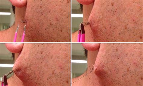 Beautician doing laser hair removal treatment on armpits. Man pulls world's longest ingrown HAIR out of his face ...