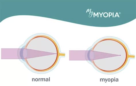I Just Learned My Child May Be Nearsighted Has Myopia Tell Me What I