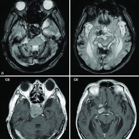 Preoperative Magnetic Resonance Images A Atrophic Change Observed In