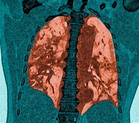 Covid-19 affected lungs - Stock Image - C049/9744 ...