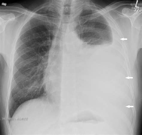 There are three recognized types of mesothelioma. Mesothelioma - Oncology - Medbullets Step 2/3