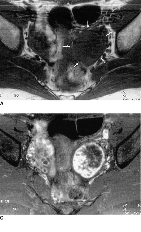 Sclerosing Stromal Tumor Of The Left Ovary In A 26 Year Old Woman A