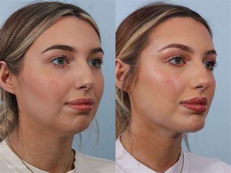 Chin Augmentation Before And After Pictures Williams Center Williams Center