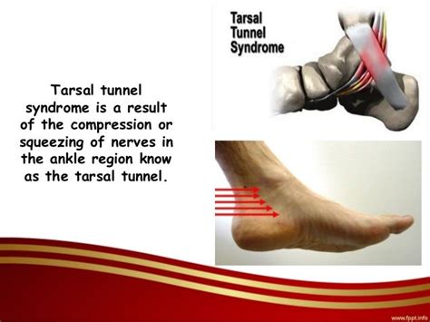 Physical Therapy Exercises For Tarsal Tunnel Syndrome Online Degrees