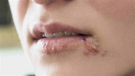 Sun Blisters On Lips 5 Best Treatments In 2022 Natural Way