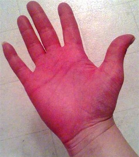 Erythromelalgia Presenting After Neurosurgical Intervention In A