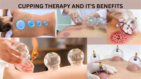 Cupping Therapy And Its Benefits Physiofitfinder