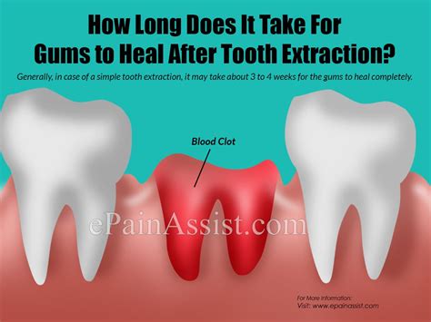 How Long Does It Bleed After Tooth Extraction And How To Stop The Bleeding