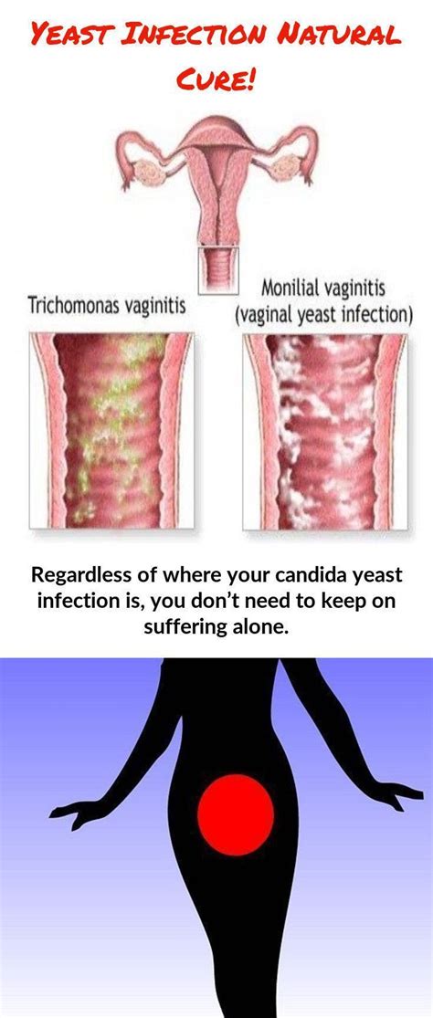 Pin On Yeast Infection Treatment