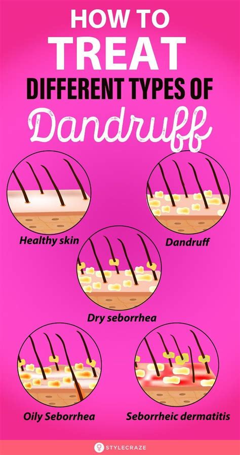 Different Types Of Dandruff And How To Stop Them In 2021 Dandruff