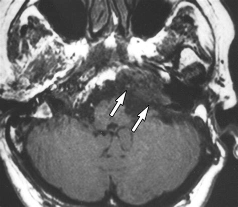 Diffusion Weighted Mr Imaging Of Cholesteatoma In Pediatric And Adult
