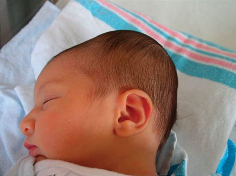 Newborn Baby Head Swelling Newborn Baby
