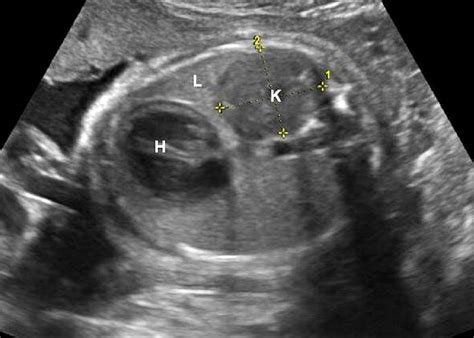 Transverse Fetal Lie Ultrasound