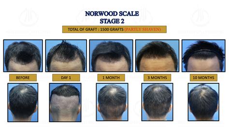 Norwood Stage Hair Transplant Centre Malaysia Hair Treatment