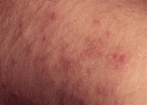 What Is An Amoxicillin Rash With Pictures