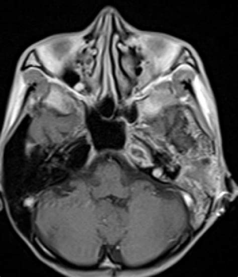 Petrous Apex Abscess Neuro Mr Case Studies Ctisus Ct Scanning