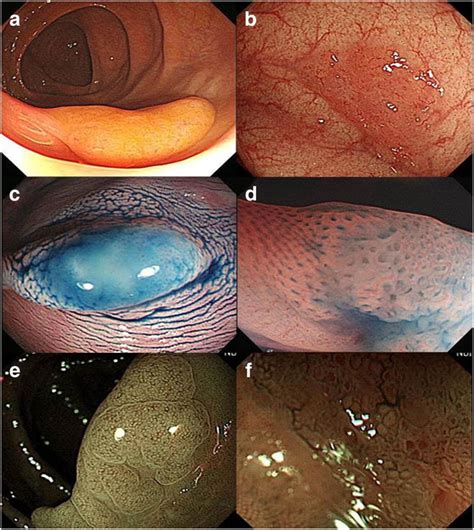 Endoscopic Characteristics Of Sessile Serrated Adenoma Polyp Imaged By