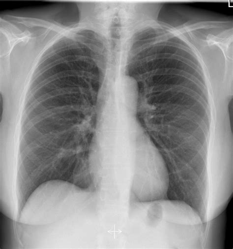 Normal Chest Radiograph Female Image Radiopaedia Org