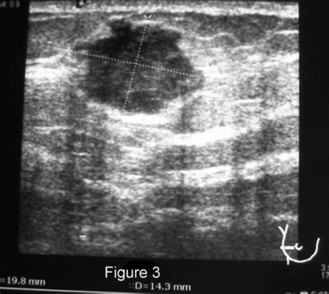 Right Breast Ultrasound From A 35 Year Old Patient With Open I
