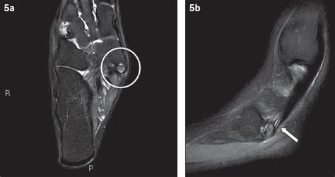 Common Accessory Ossicles Of The Foot Imaging Features Pitfalls And