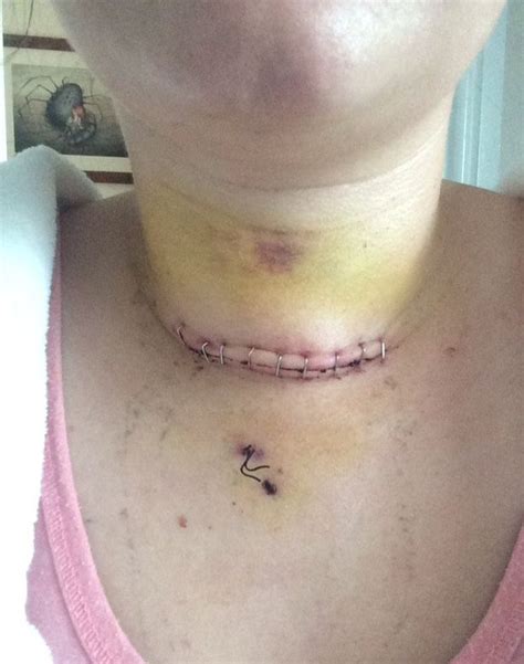 Brides Life Saved After Doctor Spotted Lump On Neck During Honeymoon