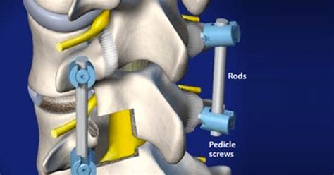 Nashville Tn Transforaminal Lumbar Interbody Fusion Tlif Dube Orthopedics
