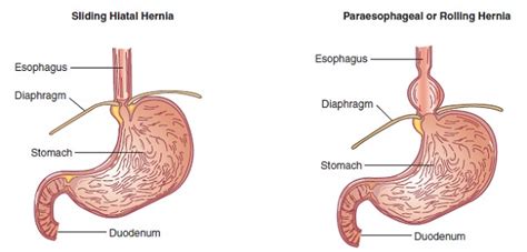 Paraesohpageal Hernia Dr Scott Laker Michigan Surgery