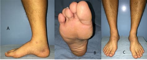 A 19 Year Old Male Patient Presented With Recurrent Ankle Sprains On