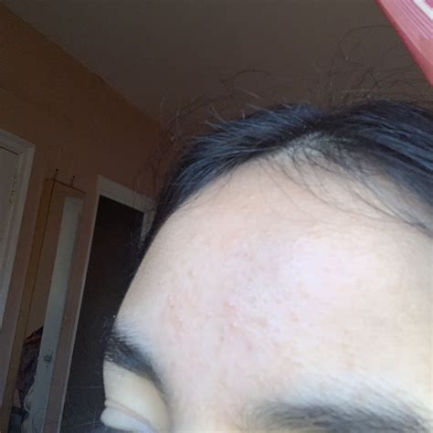 Forehead Bumps General Acne Discussion Acne Org Forum