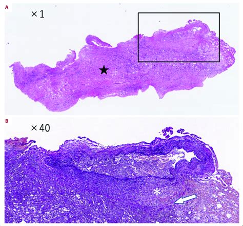 Pathological Findings A Hematoxylin And Eosin Stain ×1 Edematous