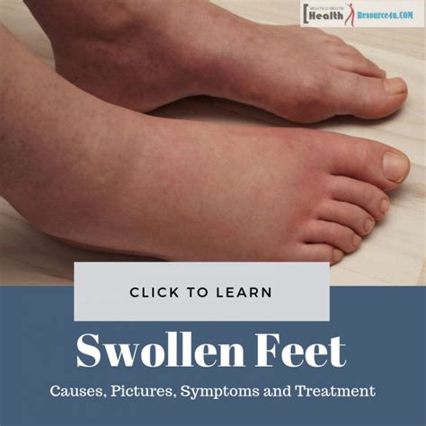 Swollen Feet Causes Pictures Symptoms And Treatment