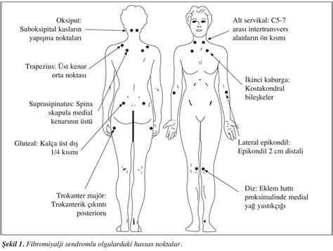 Amerikan romatoloji koleji'nden olduğunu ve arthritis care. Fibromiyalji hassas noktaları Nedir, Belirtileri Nelerdir ...