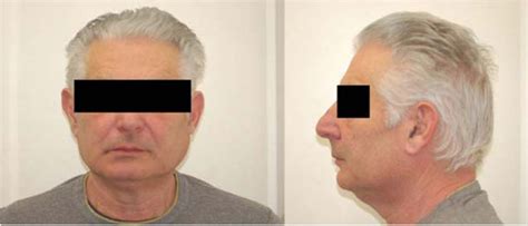 Fig 1 Unilateral Parotid Swelling On The Left Side Frontal And