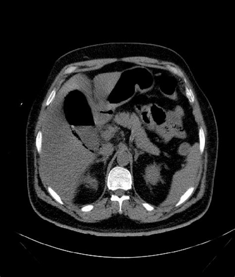 A The Ct Scan Showing A Distended Thickened Wall Gallbladder