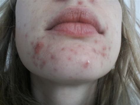 Cystic Chin Acne General Acne Discussion By Cherrybomb