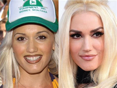 Has Gwen Stefani Had Cosmetic Surgery Mya Cosmetic Surgery