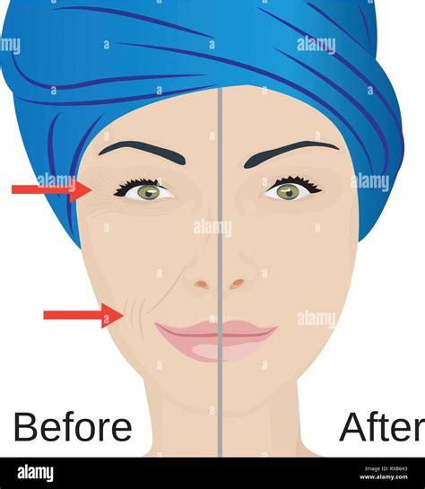 Aging Face Treatment Before And After Rejuvenation Face Lifting