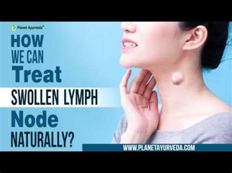 How We Can Treat Swollen Lymph Node Naturally Youtube