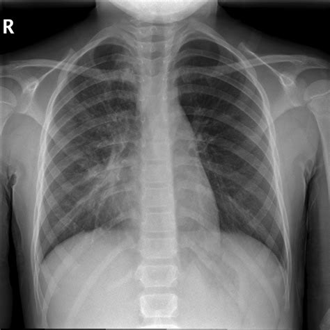 Notes On Paediatric Chest Radiography Wikiradiography