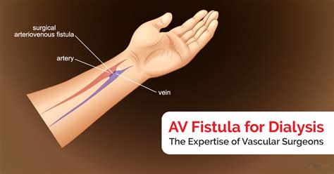 Av Fistula For Dialysis The Expertise Of Vascular Surgeons