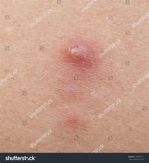 Pimple Extreme On Human Skin Macro Stock Photo 168739121 Shutterstock