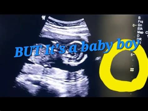 How To Tell Gender On Ultrasound Part Wrong Gender Reveal On Ultrasound Baby Girl Or Boy